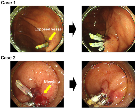 In Focused Communications, Akizue et al explain 'Utility of prophylactic clipping after colorectal cold snare polypectomy in patients on oral antithrombotic agents.' giejournal.org/article/S0016-… @DarylRamai