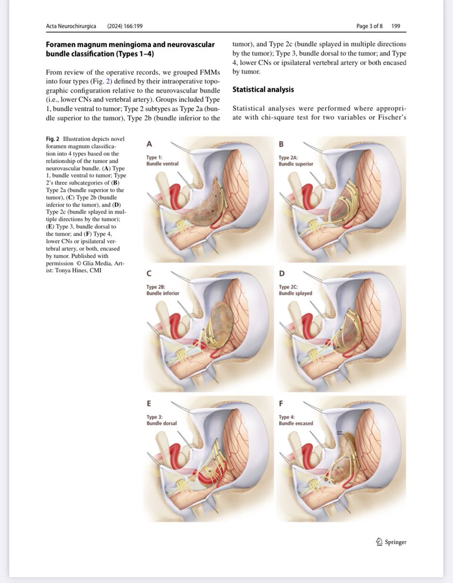 The Youssef/Baskaya classification for foramen magnum meningioma is finally out. Original art illustration was developed with the great talented Tonya Hines! Thank you everybody that contributed to this novel addition.