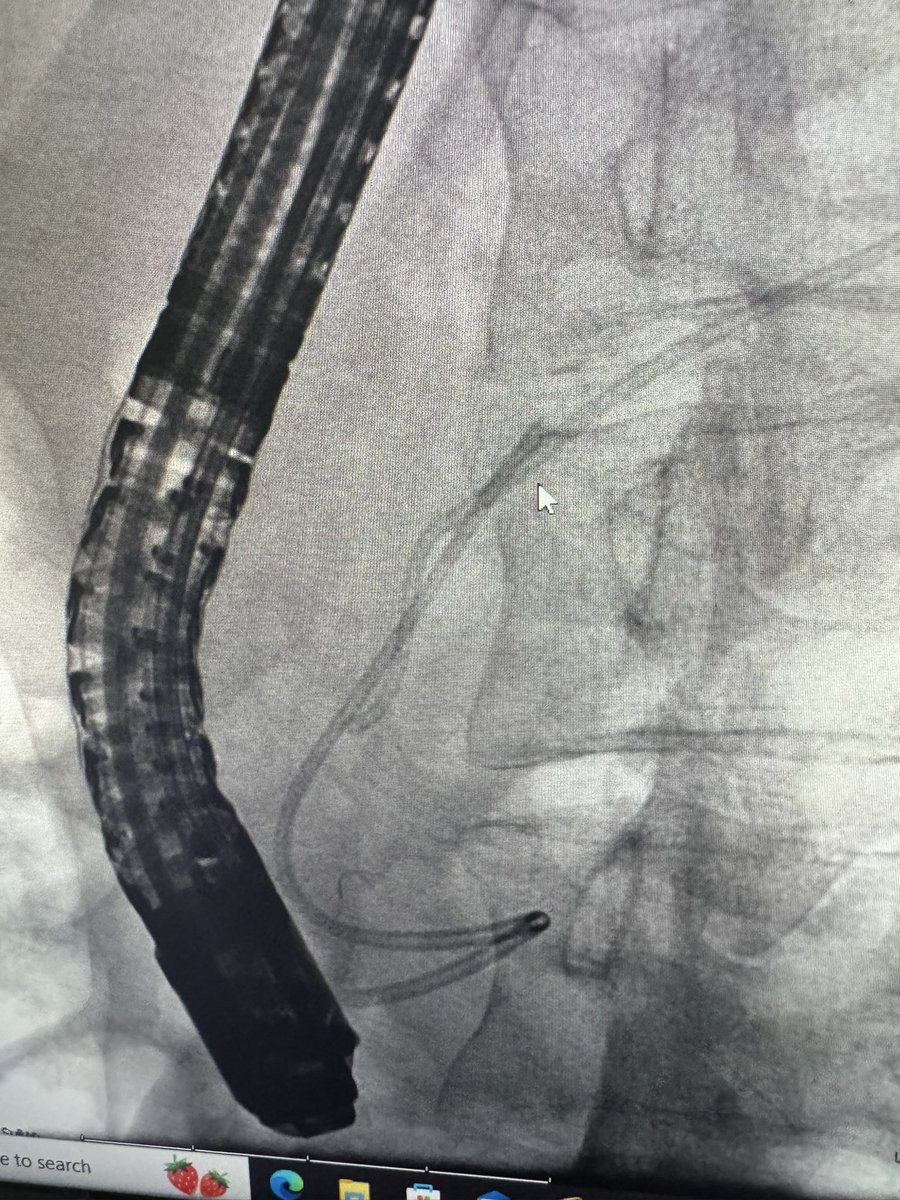 #GItwitter any tricks to get this migrated PD stent out? 4cm x 5 single pigtail stent . There is a 5F 11mm extraction balloon alongside it to give an idea bout the trajectory of PD. Couldn’t pull it out with an extraction balloon. Forceps wouldn’t make the turn.