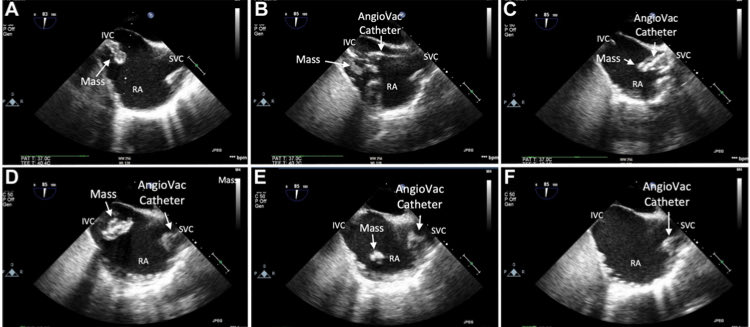 Read about our experience using AngioVac system in the latest issue of JSCAI ⁦@JaredMullinsDO⁩ @Warner8592 ⁦@MCG_AUG⁩ ⁦@MCGCardFellows⁩ ⁦@AUG_University⁩ @MCG_InternalMed⁩ #JSCAI #AngioVac #WellstarCVTeam doi.org/10.1016/j.jsca…