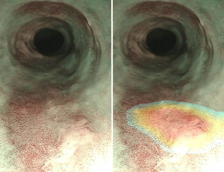 A new #DeepLearning platform assists endoscopists with detecting high-risk esophageal lesions during routine #endoscopies, providing a powerful tool for earlier diagnosis and treatment of #EsophagealCancer. @ScienceTM scim.ag/6Nk