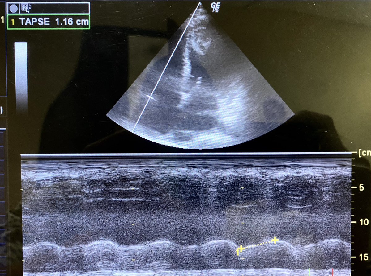 Postpartum G1P1A0. 28 y.o. 
SOB, dizziness, and fatigue for 1 month since peripartum. Edema in both legs 
No cardiovascular risk before pregnancy, but elevated blood pressure at last ANC
What do you see?? #Cardiology #echofirst #echo