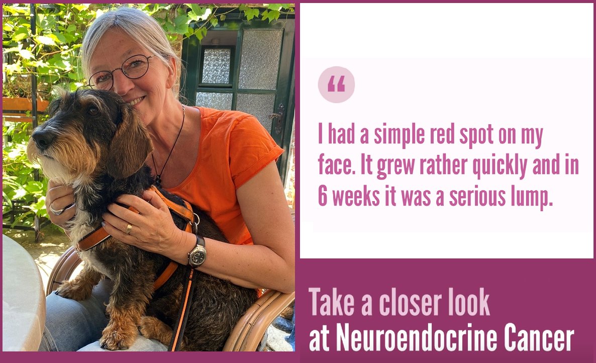 Merkel Cell Carcinoma (MCC) accounts for about a third of rare skin cancers. 👉Mariska (the Netherlands) was lucky to get a diagnosis in 6 weeks. Her GP suspected something uncommon and sent her for biopsy. ✅Watch Mariska’s story: incalliance.org/stories/marisk… #LetsTalkAboutNETs