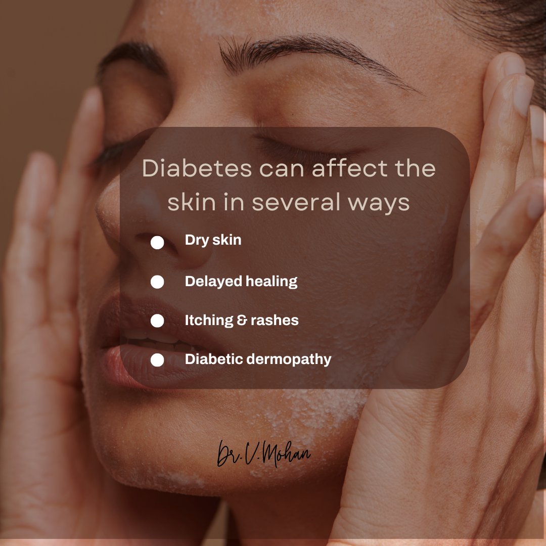 Do you know? Skin problems are common in people with diabetes due to the effects of high blood sugar levels on the body over time. Diabetes can affect the skin in several ways: Dry skin, Infection, Delayed healing, Diabetic dermopathy, Itching & rashes, Acanthosis Nigricans,…