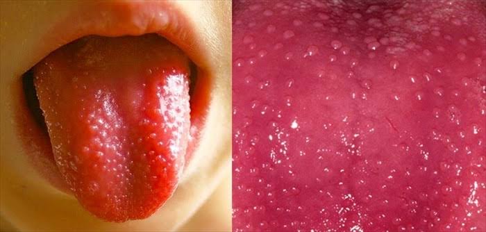 What sort of tongue's appearance is it?
#MedTwitter #medicine #media #Medicare