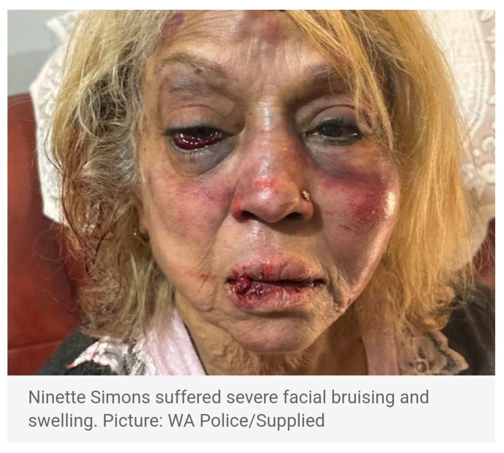 Ninette Simons, 73, beaten unconscious in her home, in Perth, by illegal immigrant released by the high court of Australia 🤬