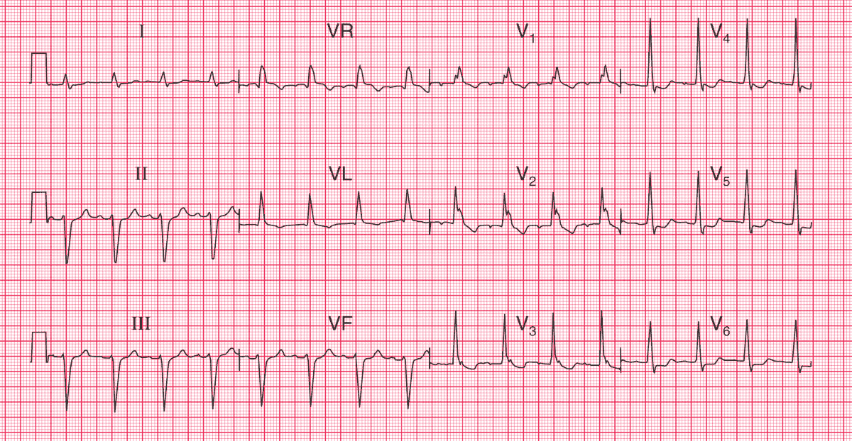 A 70 y/o man is sent to the clinic because of rather vague attacks of dizziness, which occur approximately once per week. - What's your interpretation ? ➡️ Answer and Interpretation: manualofmedicine.com/ecgs/ecg-case-… #medtwitter #foamed #CardioTwitter