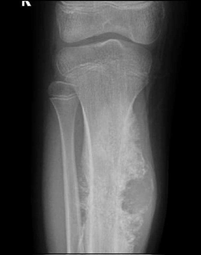 📎-The patient presents with bone pain, weight loss, fatigue and anaemia. 
🕵️-X-ray showed this. 
❓What is your diagnosis?

Noor Medical & Rehab Center 

@fxgodzeuss @IhabFathiSulima #MedTwitter #MedEd @DrMomin79