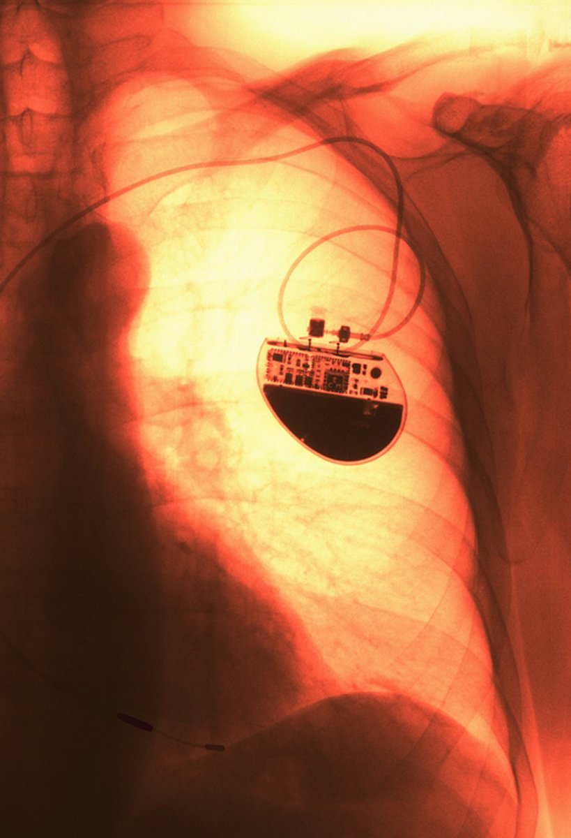 CUP_RDirections's tweet image. 🟣 How do we overcome the current limitations of environmental bioelectronic sensors? ask #RDBioelectronics EiC Prof Samit Chakrabarty @sc_laboratories &amp;amp; Dr Heyu Yin

Find out how to contribute your research in response ➡️bit.ly/44H6yIQ

 #bioelectronics #bionics