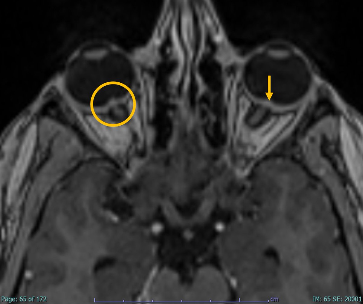 Papilledema (swelling of the optic disc, nerve head, or papilla) is a sign of raised intracranial pressure. It is best seen on fundoscopic examination but also in imaging.  

MRI findings: 

1. Protrusion of the optic nerve head (papilla) into the globe is seen as a bright dot at