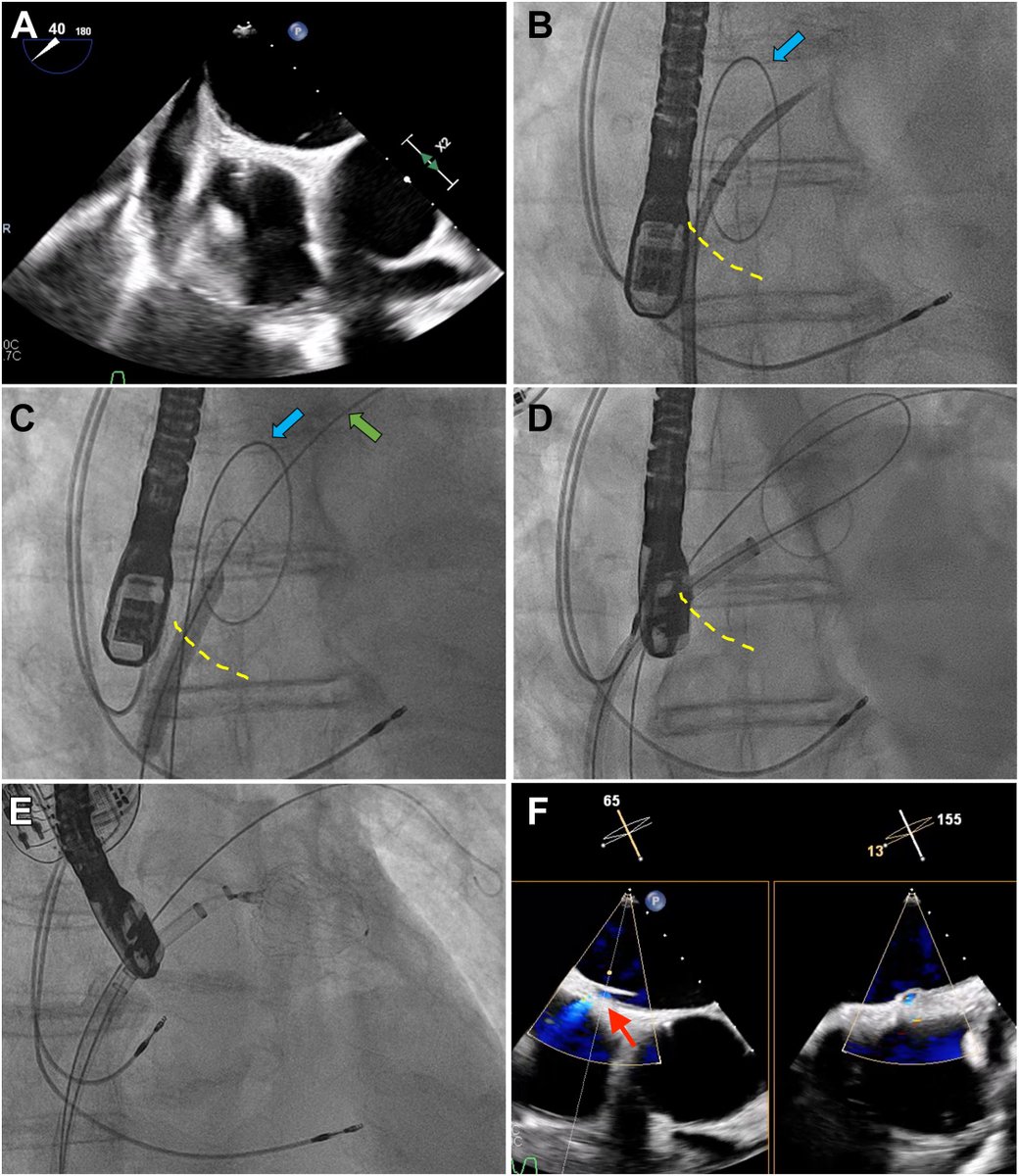 💡 Buddy wires strategy can be used when the interatrial septum cannot be crossed by any delivery sheath during left atrial appendage closure interventions. Read more 👉onlinecjc.ca/article/S0828-… #CJC