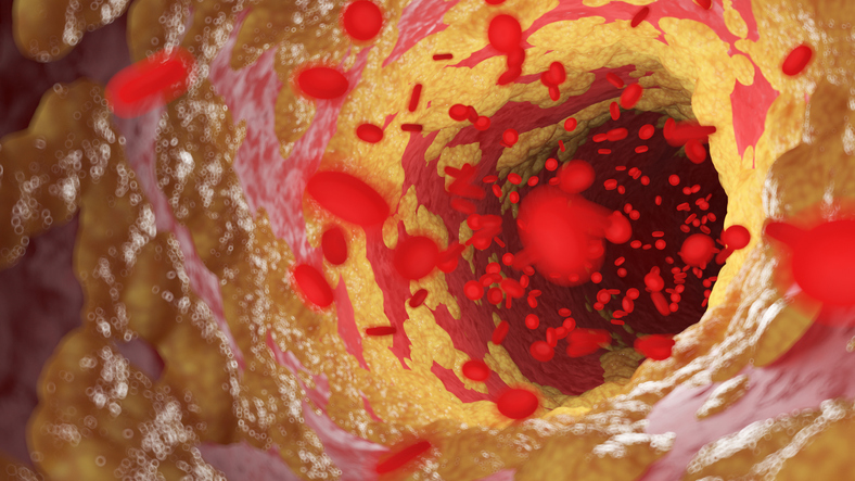 Atherosclerosis Has Tumor-Like Features, May Be Countered by Anticancer Drugs Atherosclerosis involves cellular transitions that are similar to those seen in tumors, and that may be prevented by anticancer drugs. Learn more: ow.ly/fGxE50Rtswc