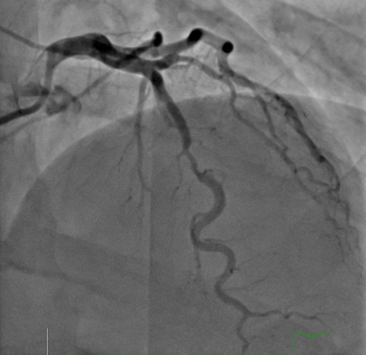 Half of patients doing angiogram for stable angina are diagnosed w/ ischemia w/ no obstructive coronary artery disease.

Spectrum of Ischemic HD Throughout a Woman’s Life Cycle - Drs @smitha_narayana Sai Sita Garapati & Karla Kurrelmeyer

#DeBakeyCVJournal doi.org/10.14797/mdcvj…