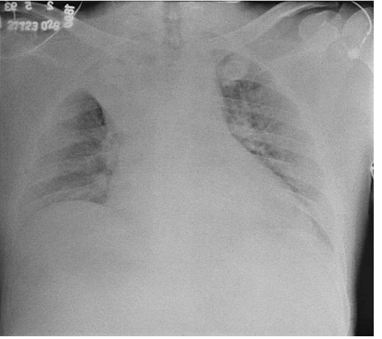 An elderly male 75years old had and onset streaky hemoptysis 
What's radiology sign ?
Explain findings on the. X-ray 
Dx?
@PeterItebimien /@IhabFathiSulima /@TSM_Humanist /@Mota55em