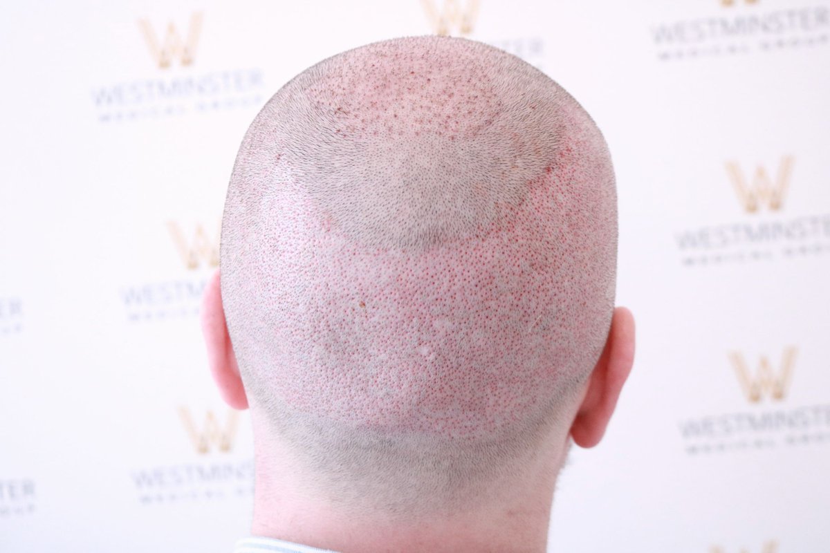 Superior extraction and implantation every time here on Harley Street👌

Click 👉 wmglondon.com

#westminstermedicalgroup #wmg #fuehairtransplant #hairclinic