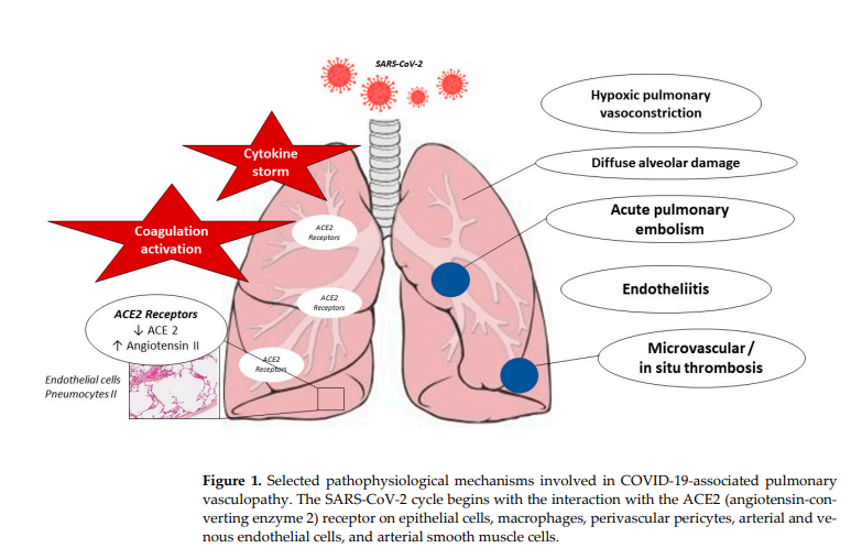 Mechanisms of Pulmonary Vasculopathy in Acute and Long-Term COVID-19: A Review ❗Very interesting review study on Covid-19 associated pulmonary vascular damages, a possible long-term initially silent major pathology😢 ➡️“With the constant mutation of the virus and the new…