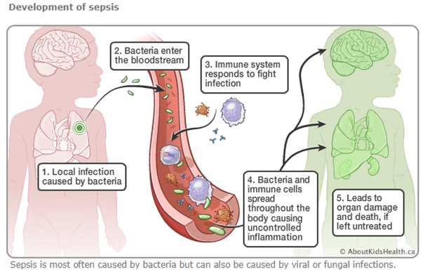 What are the signs and symptoms of sepsis? A child with sepsis may display typical signs of an infection, including #fever, #cough or #diarrhea, along with: ow.ly/kVYV50Rj0gZ #Sepsis
