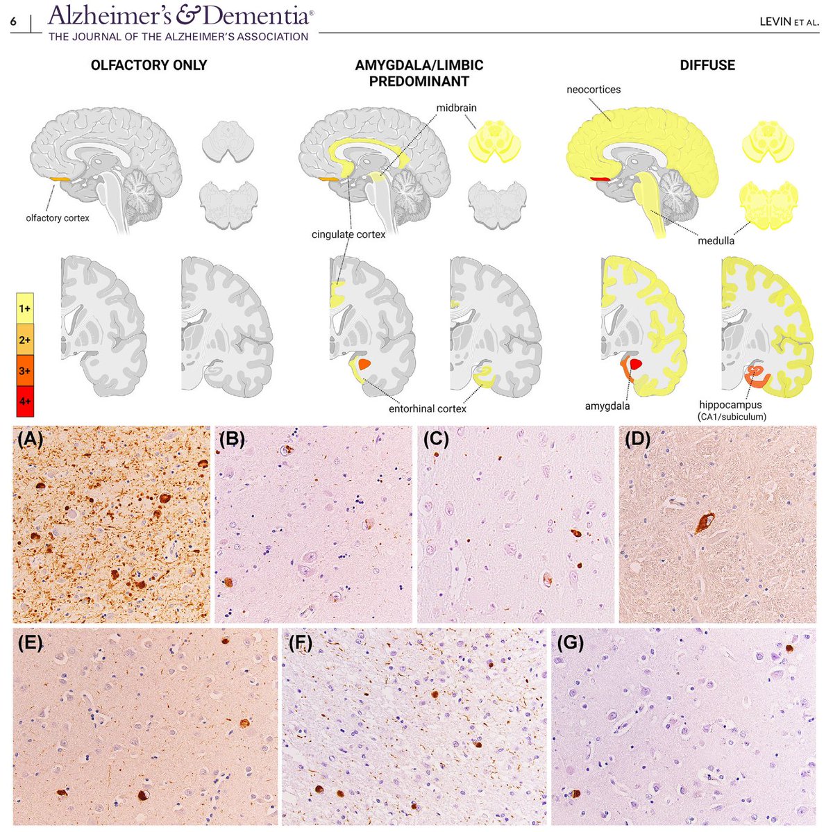 Lewy body pathology is found in ~50% of both sporadic and familial Alzheimer's disease. Levin et al. showed that: 1. 0/26 of asymptomatic and 3/27 (11%) of symptomatic AD mutation carriers tested positive on an α-synuclein seed amplification assay (SAA) in cerebrospinal fluid.…