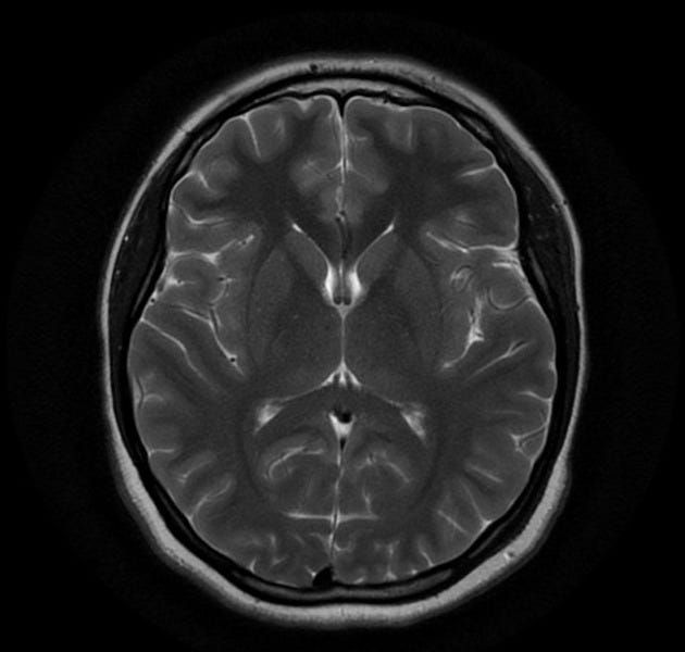 Is it possible to have MS when there is no evidence of demyelination on the MRI brain? In short, yes, you can have MS with a normal MRI. However, the answer is much more complex than a simple yes or no answer …… #MS_Selfie Q&A 31 => buff.ly/3V3fcNX