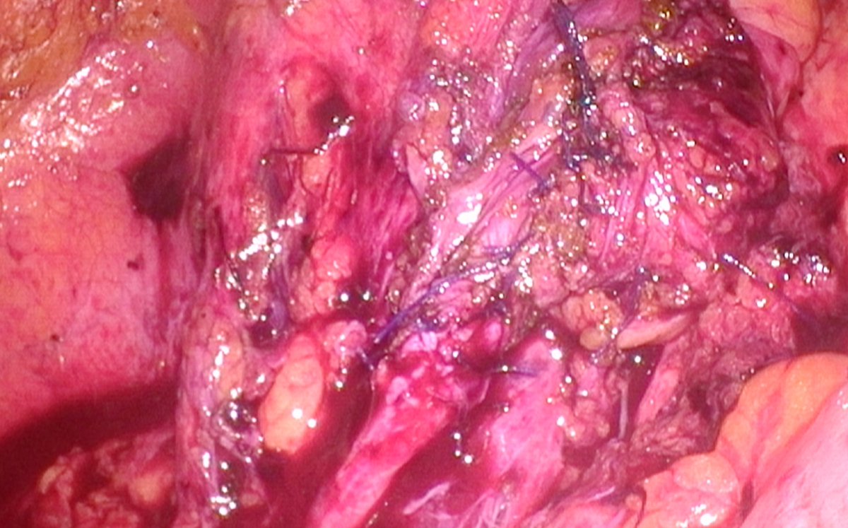 youtu.be/irlnK99M6DI Robotic boari flap with SSI mantra robo . Difficult case Ursl for small stone, perforation of ureter, urinoma and then referred to us. PCN, PCD done. Rirs antegrade , flexi nephroscope and opposite side RIRS removed all stones. Now the boari flap is…