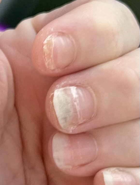 You wouldn’t think that fingernails pealing both up AND down would make you wake up at higher, but you’d be wrong. 

Chemo plus anaphylaxis making my fingers fat sausages have made the ones extra white feel dead, all others are just ablaze. Stupid chemo allergy.