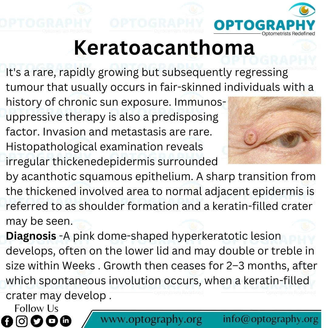 Keratoacanthoma is a relatively common benign skin tumor that often appears on sun-exposed skin. It typically grows rapidly and resembles squamous cell carcinoma, but it usually resolves on its own within a few months.
#Optography 
#Optometry #Optometrist 
#Keratoacanthoma