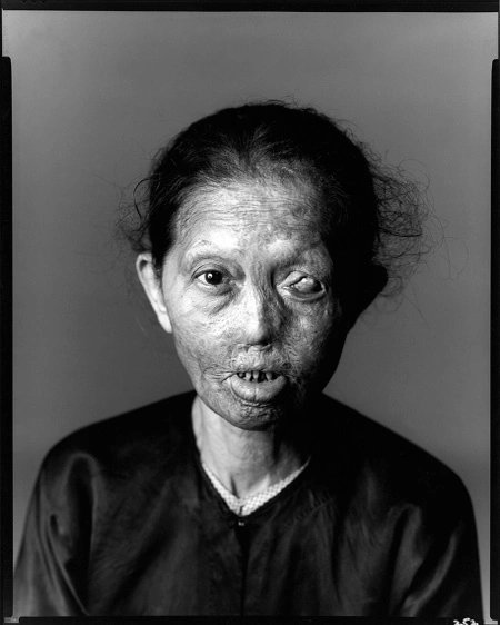A photo taken by Richard Avedon of a Vietnamese victim of napalm. Some Vietnam protests targeted the colleges that worked with napalm producers; in October 1967, students at UW–Madison protested Dow Chemical's presence on campus, asking the uni to cut all ties with Dow.