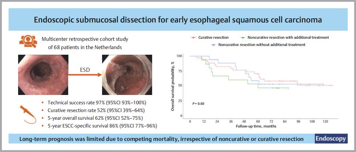 Endoscopic submucosal dissection for early esophageal squamous cell carcinoma: long-term results from a Western cohort by Ilse N. Beaufort et al. Find the article at: doi.org/10.1055/a-2245…