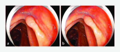 Linked-color imaging with or without artificial intelligence for adenoma detection: a randomized trial by Kazuya Miyaguchi et al. Find the article at: doi.org/10.1055/a-2239…