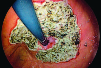 E-Video: Hybrid argon pasma coagulation-assisted mucosal ablation in the management of refractory gastroesophageal reflux disease by Yun Bao et al. Find the full text and video here: doi.org/10.1055/a-2229…