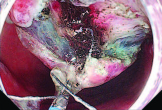 E-Video: Endoscopic submucosal dissection of early gastric angle cancer by using a simplified robot-assisted device for traction by Can Cui et al. Find the full text and video here: doi.org/10.1055/a-2227…