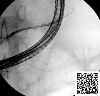 E-Video: Endoscopic ultrasound-directed transgastric ERCP for disconnected pancreatic duct syndrome: finding the edge to bridge the gap by Mark Henrik Bonnichsen et al. Find the full text and video here: doi.org/10.1055/a-2266…