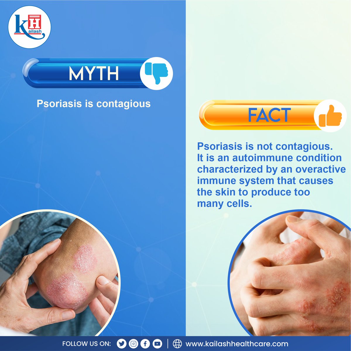 Is Psoriasis contagious? Here's debunking myths about #psoriasis !

Consult our Skin Specialists: kailashhealthcare.com

#skinhealth #psoriasiscare #skinallergy #tchiness #skintreatment
