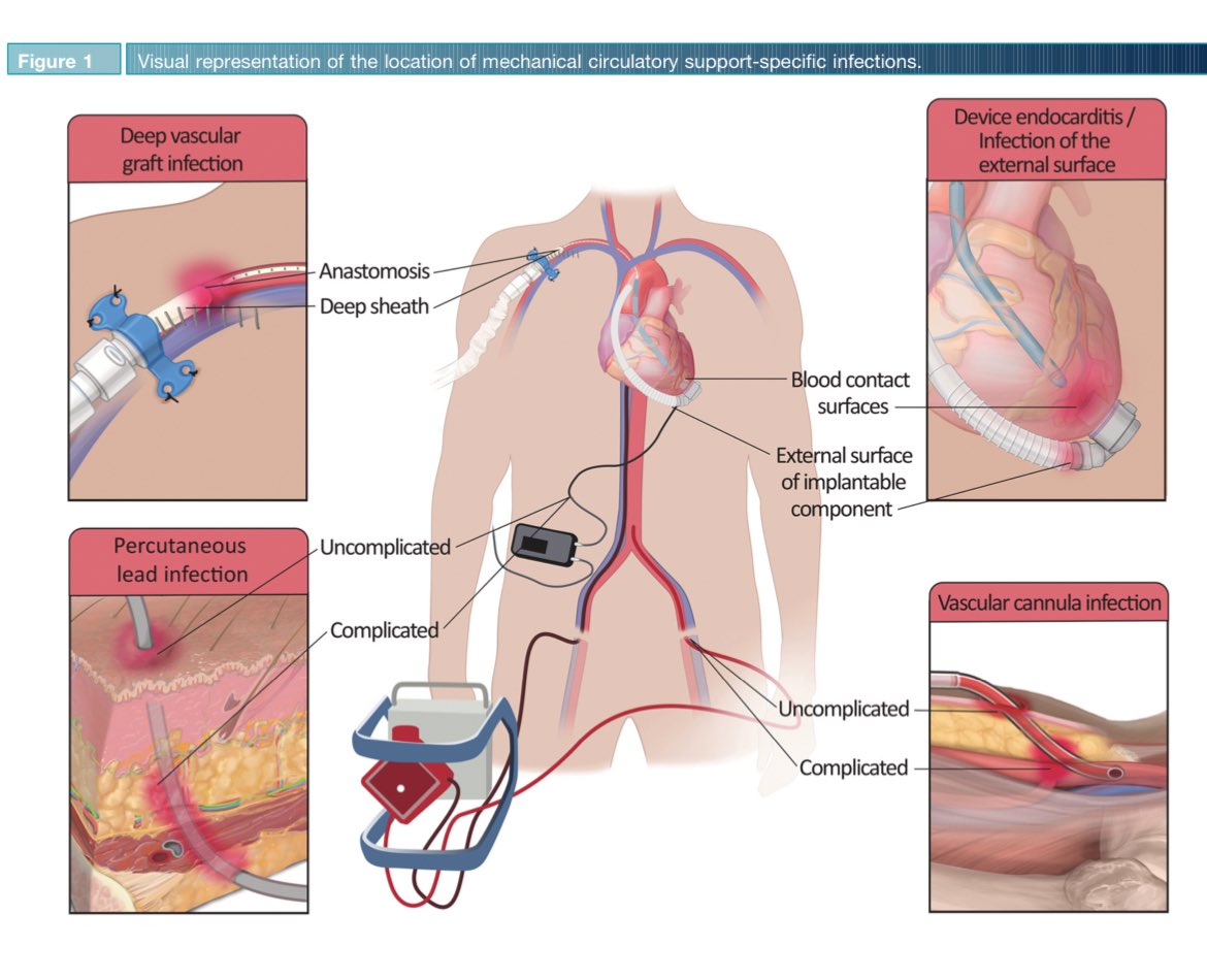 📌Consenso: Definiciones de infección en soporte circulatorio mecánico de corta y larga duración de @ISHLT in @TheJHLT Disponible en: bit.ly/44nNRL9 Que honor haber participado dentro de este panel de expertos desde el área de la insuficiencia cardiaca avanzada🫀…