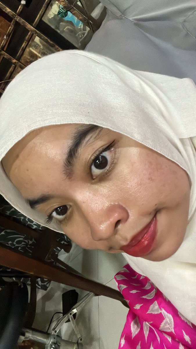 Day two of my journey without any makeup sebab buat Dermapen Scar Therapy