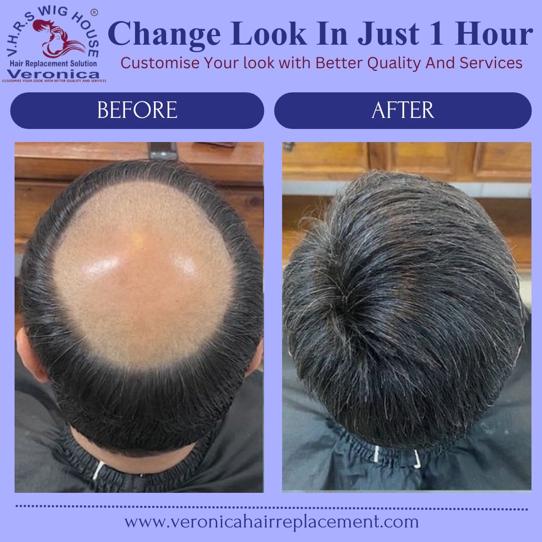 Before & After Hair Transformation in Just 1 Hour with Veronica Hair!

You can schedule a FREE consultation with Veronica Hair's experts to find the perfect hair replacement solution. 

Locations in Delhi, Noida, and Gurugram!
linktr.ee/veronicahairre…

#veronicahair #hairpatch