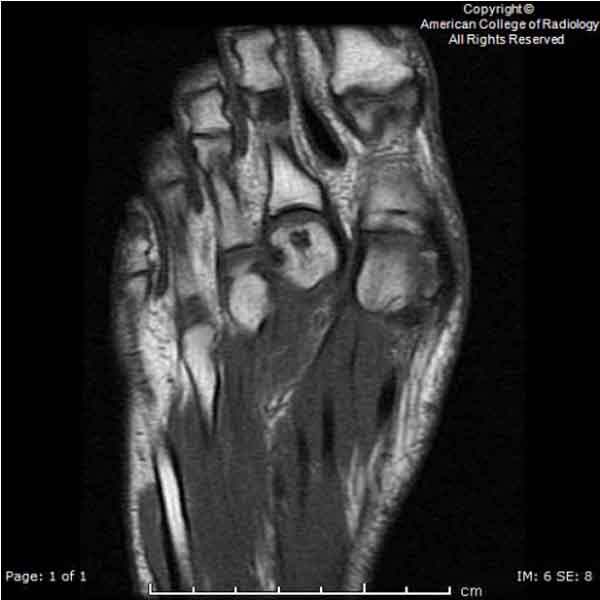 A 29-year-old previously healthy man presents with a chief complaint of a 2-month history of progressive right second metarsophalangeal joint pain…#ACRCaseinPoint bit.ly/4aPbQ8x