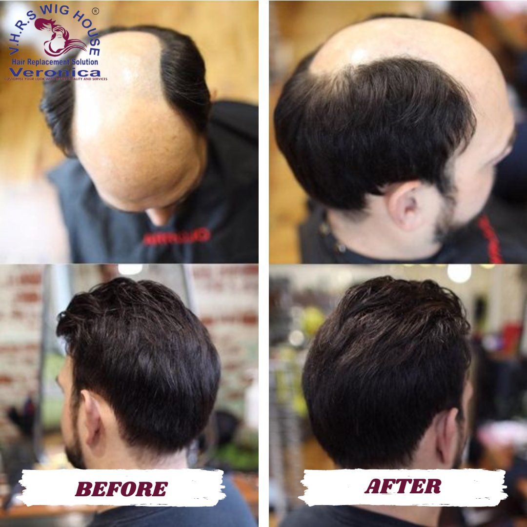 Unlock Your Inner Confidence: Hair Transformation in 1 Hour!

Schedule a FREE consultation with our experts and find the perfect solution.

Locations in Delhi, Noida, and Gurugram!
linktr.ee/veronicahairre…

#veronicahair #hairpatch #hairconfidence #instantresults #naturalhair