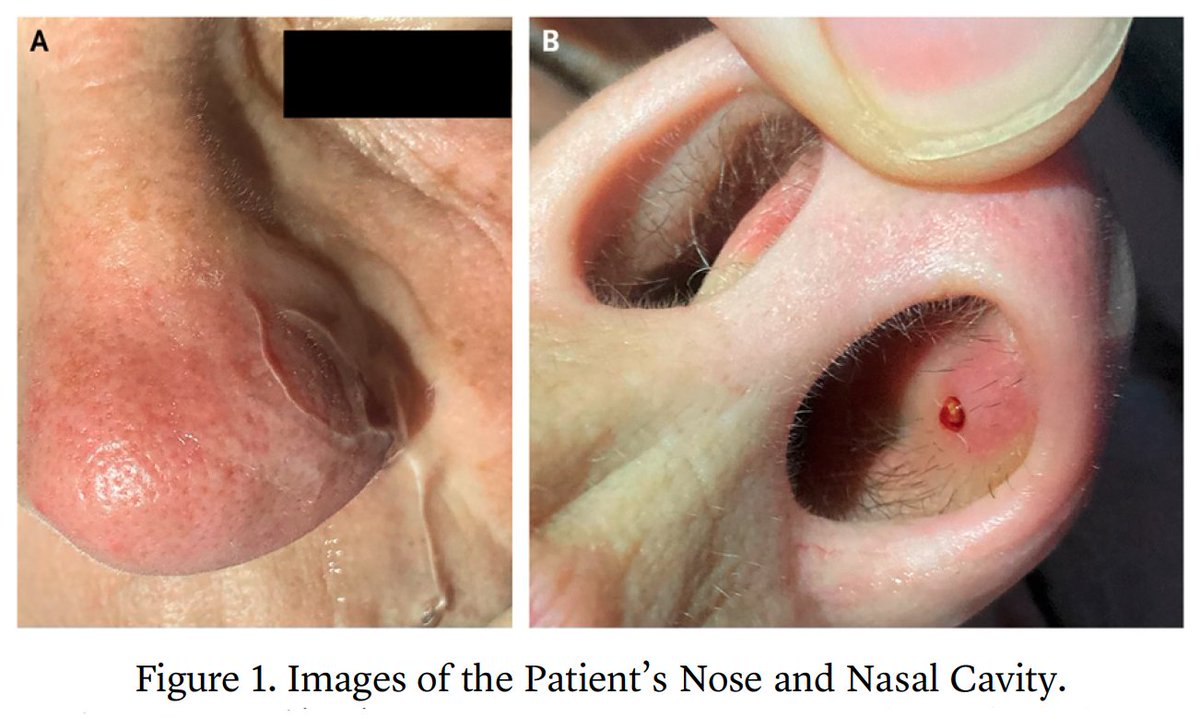 Morning Report: “A 70-Year-Old Woman with a Sensation of Something Moving in Her Nose” by Marlene M. Speth, MD, MA, et al.: eviden.cc/3IMTx7l #Otolaryngology #MedTwitter