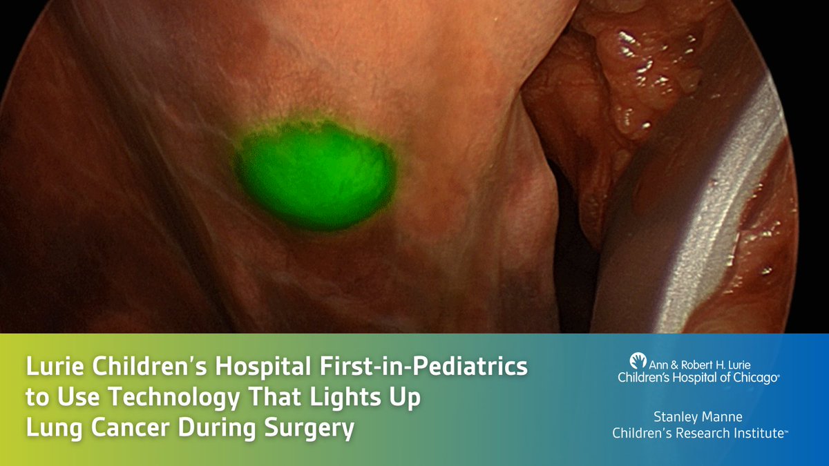 Stanley Manne Children's Research Institute (@manneresearch) on Twitter photo .@Luriechildrens is first #pediatric hospital to use novel fluorescent agent CYTALUX which allows surgeons to better see cancerous cells during lung surgery. luriechildrens.org/en/news-storie… <a href="/sethgoldsteinmd/">Seth Goldstein</a> <a href="/TimothyLautz/">Timothy Lautz</a> <a href="/NUFeinbergMed/">Northwestern Feinberg School of Medicine</a> #research .@Luriechildrens is first #pediatric hospital to use novel fluorescent agent CYTALUX which allows surgeons to better see cancerous cells during lung surgery. luriechildrens.org/en/news-storie… <a href="/sethgoldsteinmd/">Seth Goldstein</a> <a href="/TimothyLautz/">Timothy Lautz</a> <a href="/NUFeinbergMed/">Northwestern Feinberg School of Medicine</a> #research