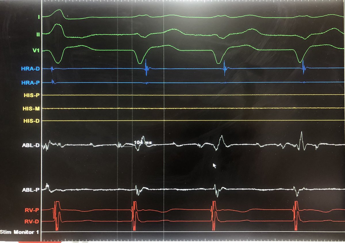 Today’s amazing case of WPW; young female with LV dysfunction (EF:35%)! Frequent AVRT with HV # 104 ms and this pattern of preexcitation👇! your thoughts? #Epeeps