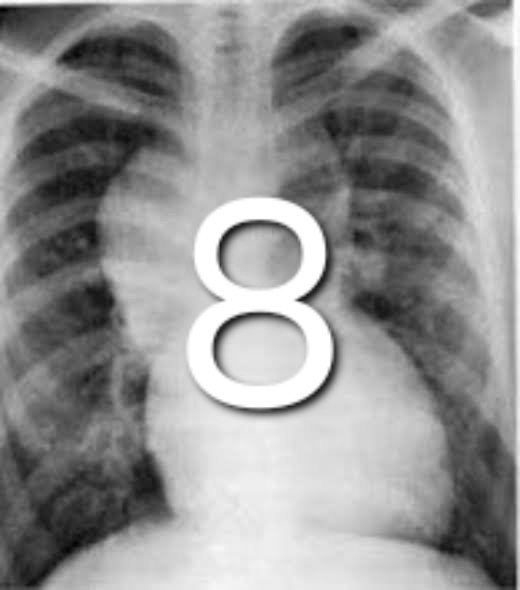 What is the diagnosis?
HINT: 8 sign/Dumbell sign/Snowman sign.
#MedTwitter #MedEd #MedX #media