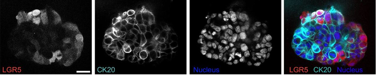 Using #ColorectalCancer patient-derived #organoids, investigators found that compared to LGR5- cells, LGR5+ #cancer stem cells were stiffer, adhered better to the 🧫 extracellular matrix, and formed larger transendothelial gaps! 📖 @NatureComms | go.nature.com/4a4MQbY