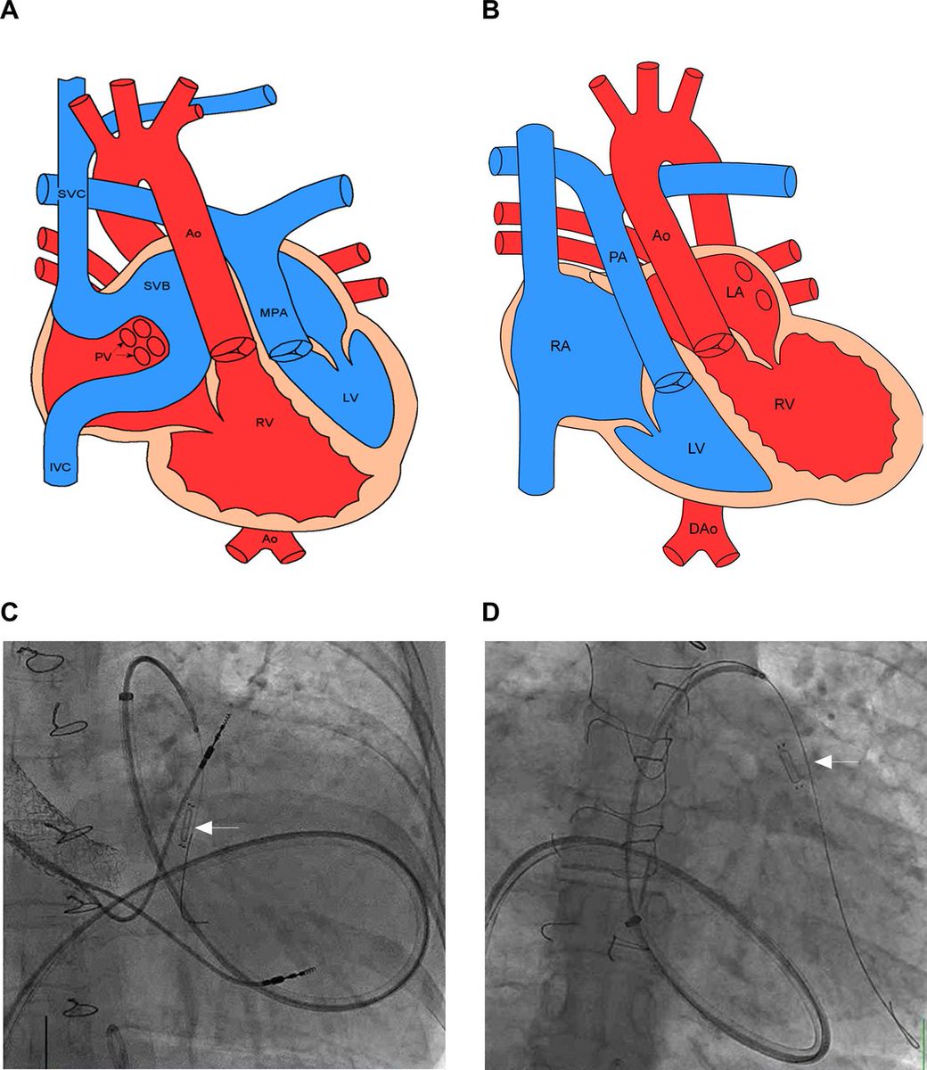 Novel uses for implanted haemodynamic monitoring in adults with subaortic right ventricles heart.bmj.com/content/early/…