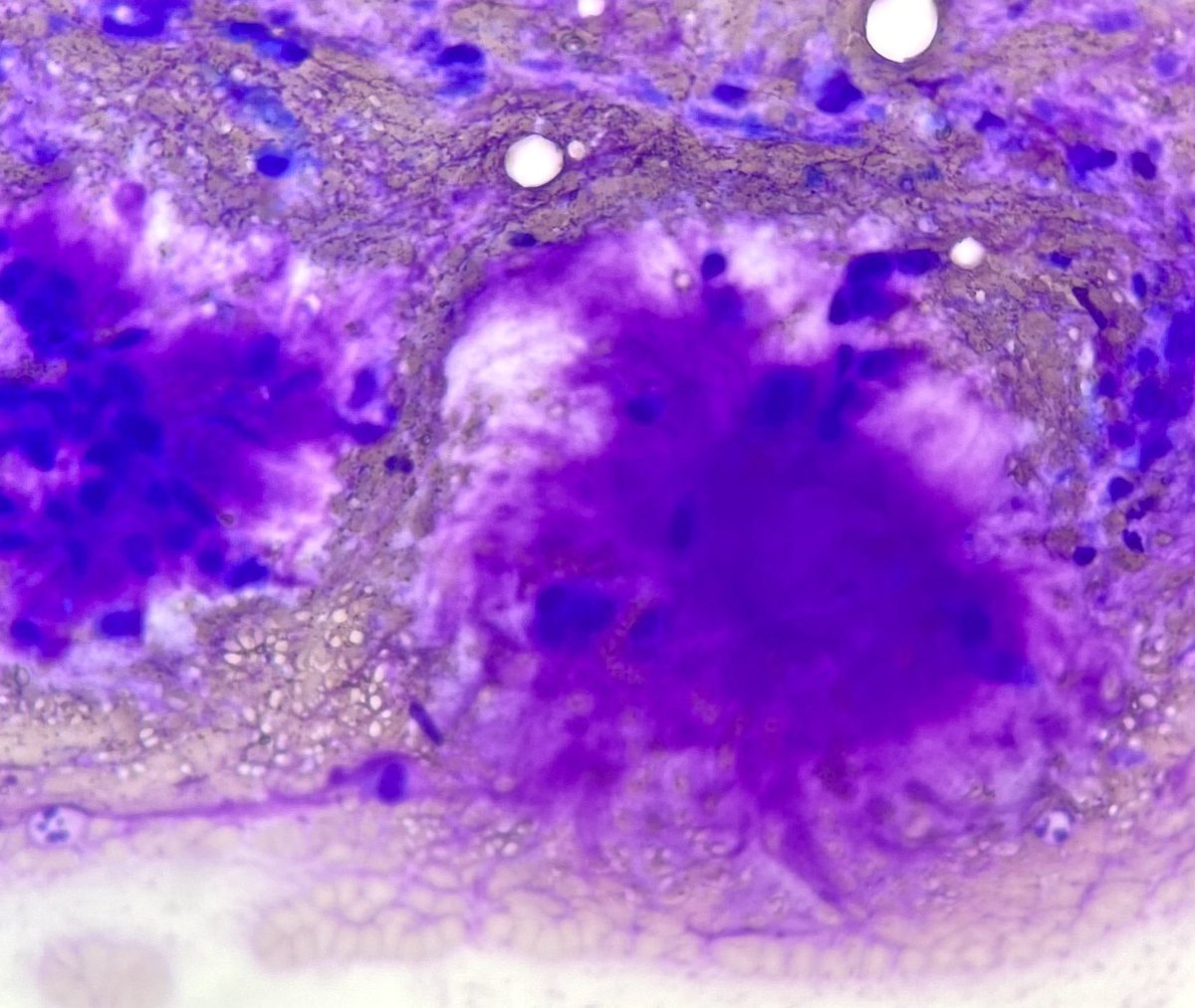 Parotid mass FNA - you can’t rely on architecture in Cytology, but the Chondromyxoid stroma and ‘trolls hair’ fibrillar metachromatic appearance on Diff-quick is classic! Read about PA 👇 #PathTwitter #PathX #Cytopath