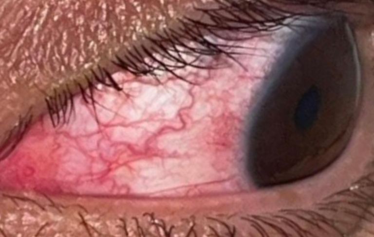 Emergency Medicine Weekly Case Challenge: Red Eye for 10 days erpocketbooks.com/p2/