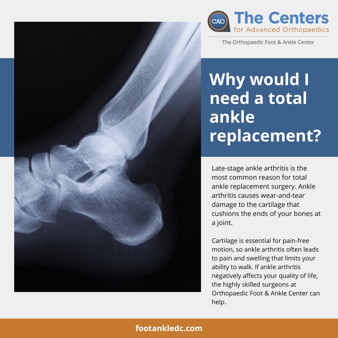 As we mark Arthritis Awareness Month, it's time to focus on solutions that can truly make a difference. Could a total ankle replacement offer you relief from arthritis pain?

#Arthritis #ArthritisAwareness #anklereplacment #Orthopedics #northernvirginia