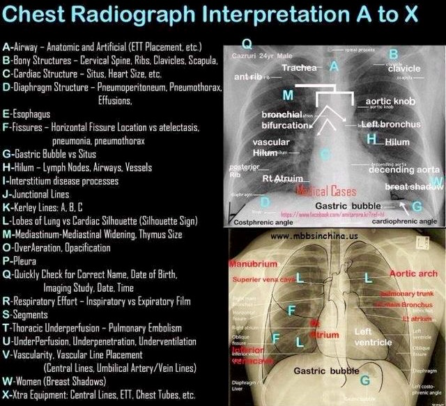 The 'A to X' pattern of chest radiography reading is one way to methodically analyze and interpret all of the elements in the x-ray