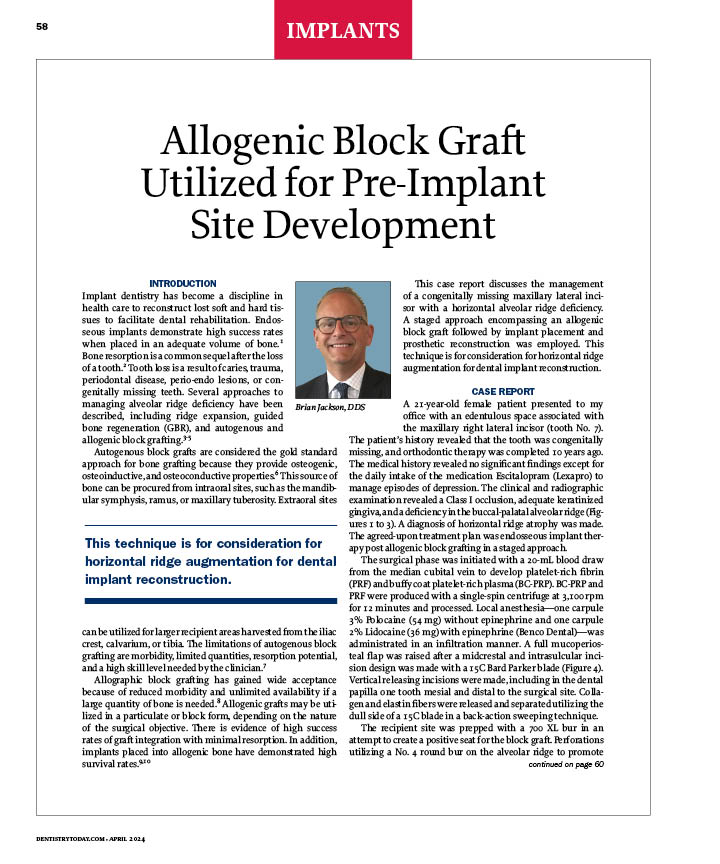 Allogenic Block Graft Utilized for Pre-Implant Site Development dentistrytoday.com/allogenic-bloc…