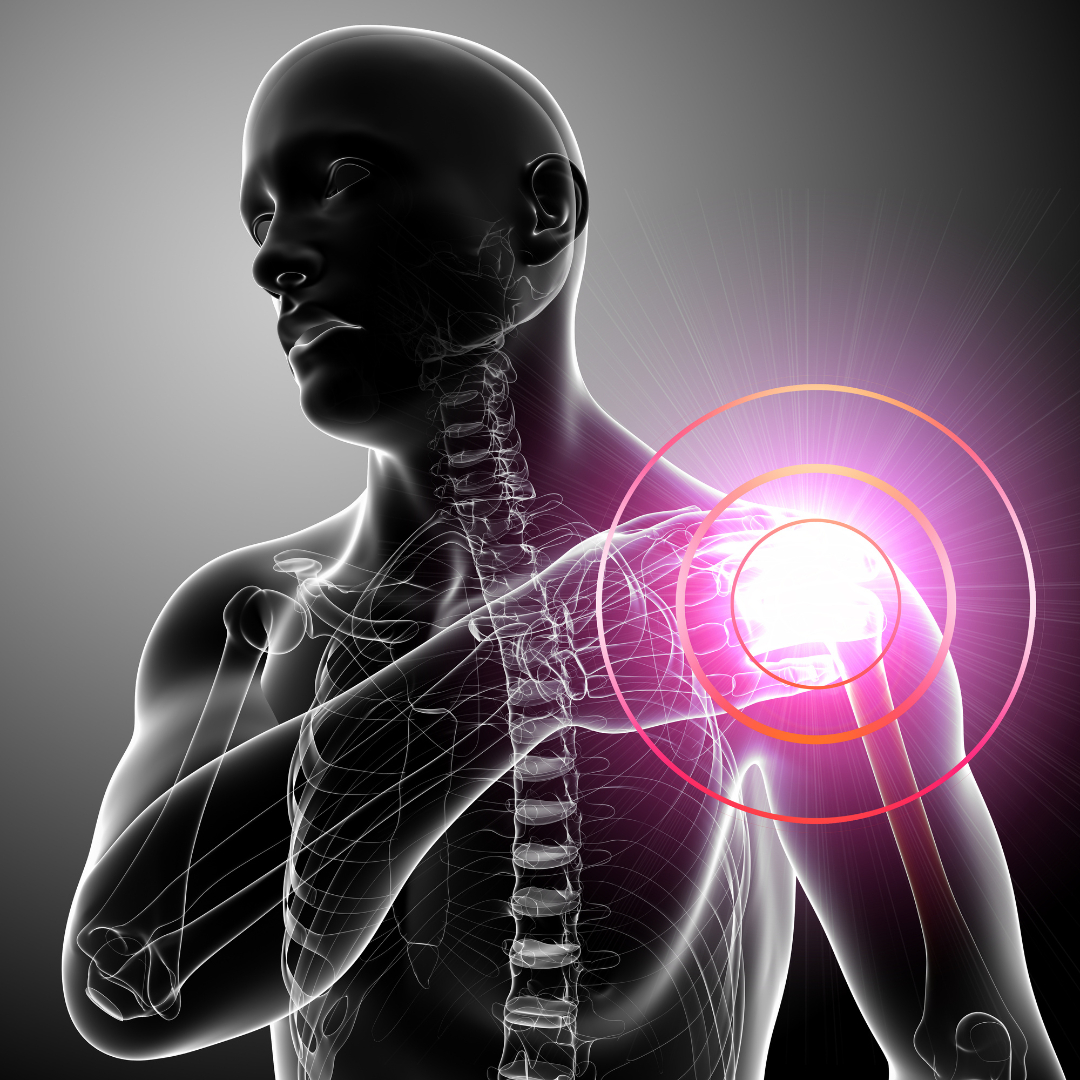 Inlay or onlay? Which design reigns supreme in reverse shoulder arthroplasty? Find out if it truly makes a difference in this informative article! medilink.us/c7pv  #medtwitter #shouldersurgery